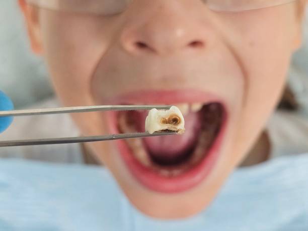 Best Dental Abscess Treatment in Cullman, AL